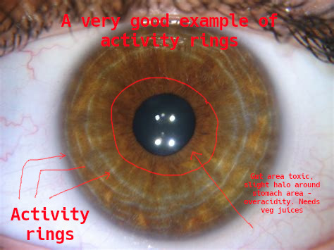 iridology_activityrings.jpg