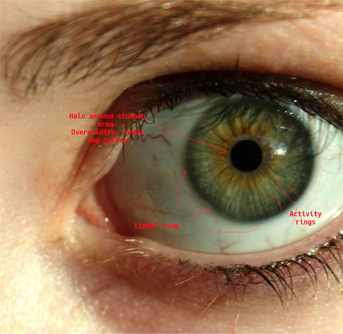 iridology_limbalring.jpg