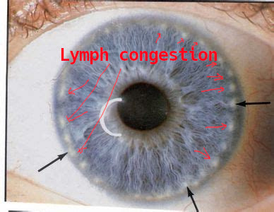 iridology_lymphaticcongestion.jpg