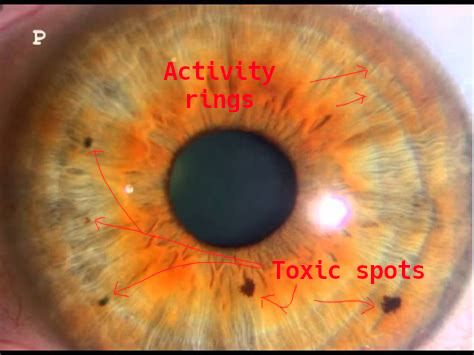 iridology_toxicspots1.jpg