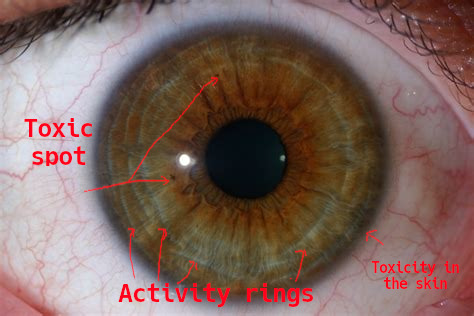 iridology_toxicspots2.jpg